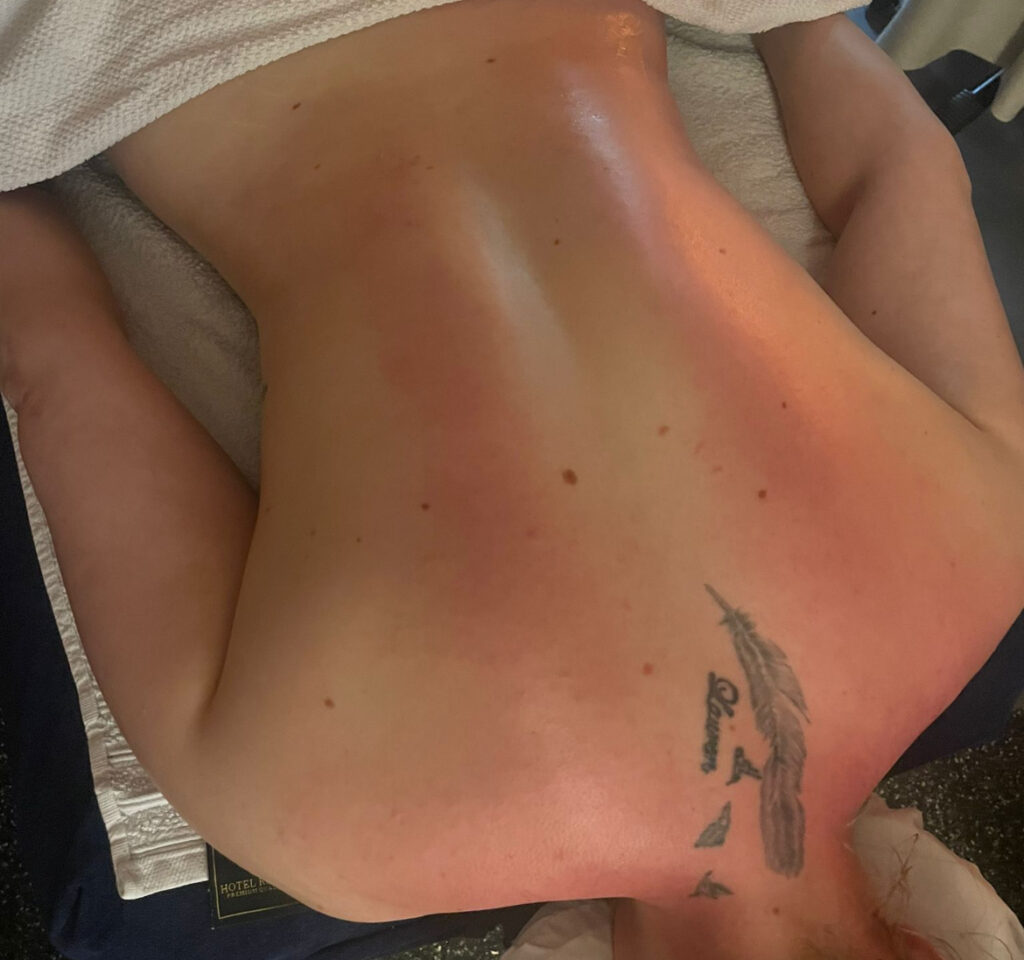 cupping naturelse